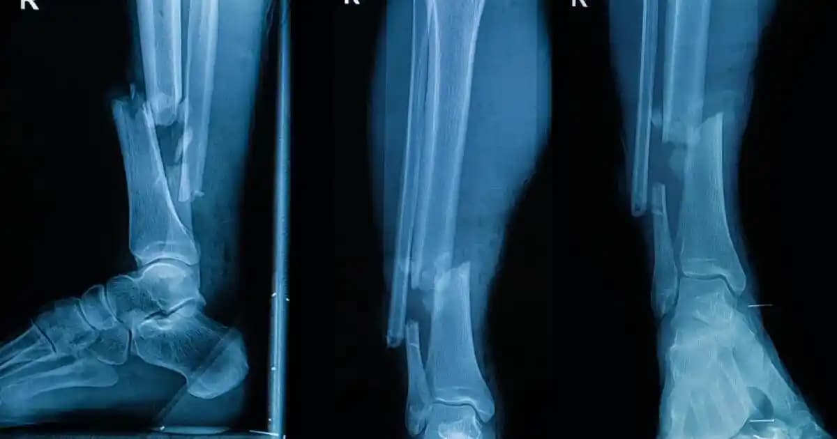 Ameliyatlarda Modifiye Tutkal Tabancası ile Doğrudan Biyobozunur Kemik Grefti Uygulaması